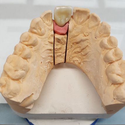 Dentallabor Zahnersatz Bild