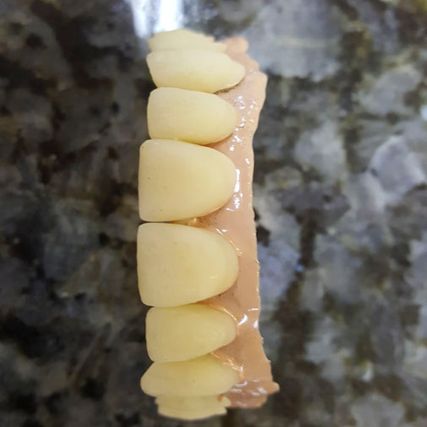Verklebung der Zähne auf Suprastruktur